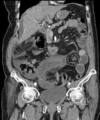 Vékonybél volvulus ischaemiával