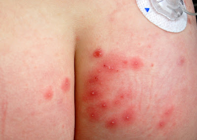 Rash On Bum Cheeks - Doctor answers on HealthTap