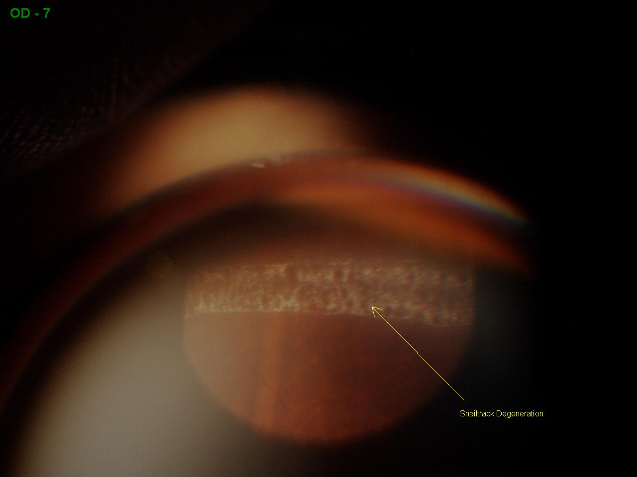 Snail Track Degeneration