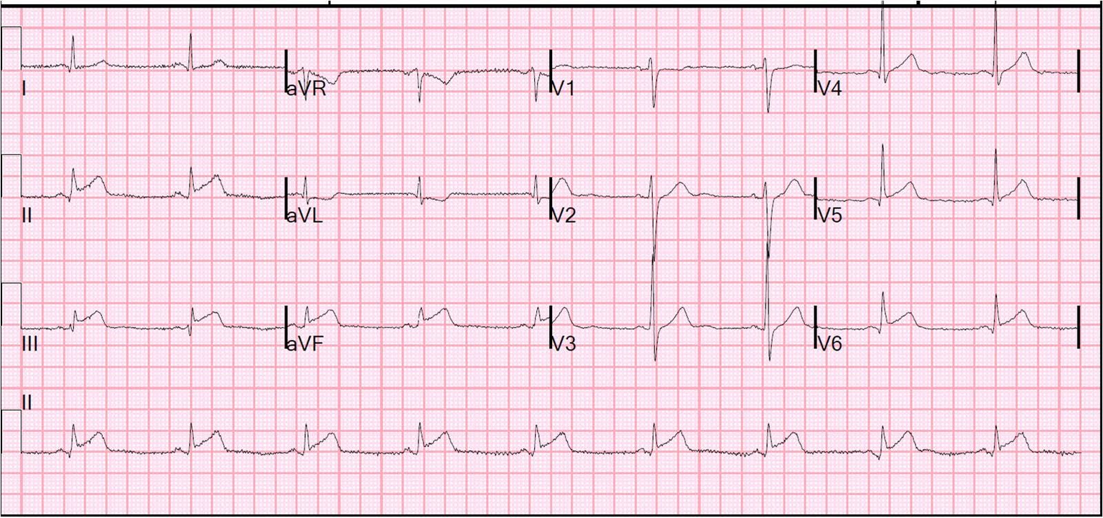 stemi score