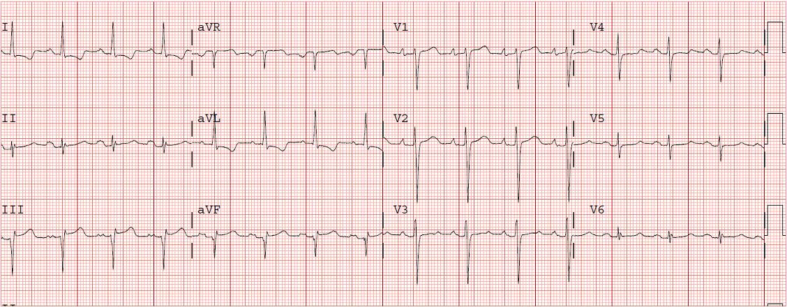 Treating Arrhythmia In Dogs Treating Arrhythmia In Dogs