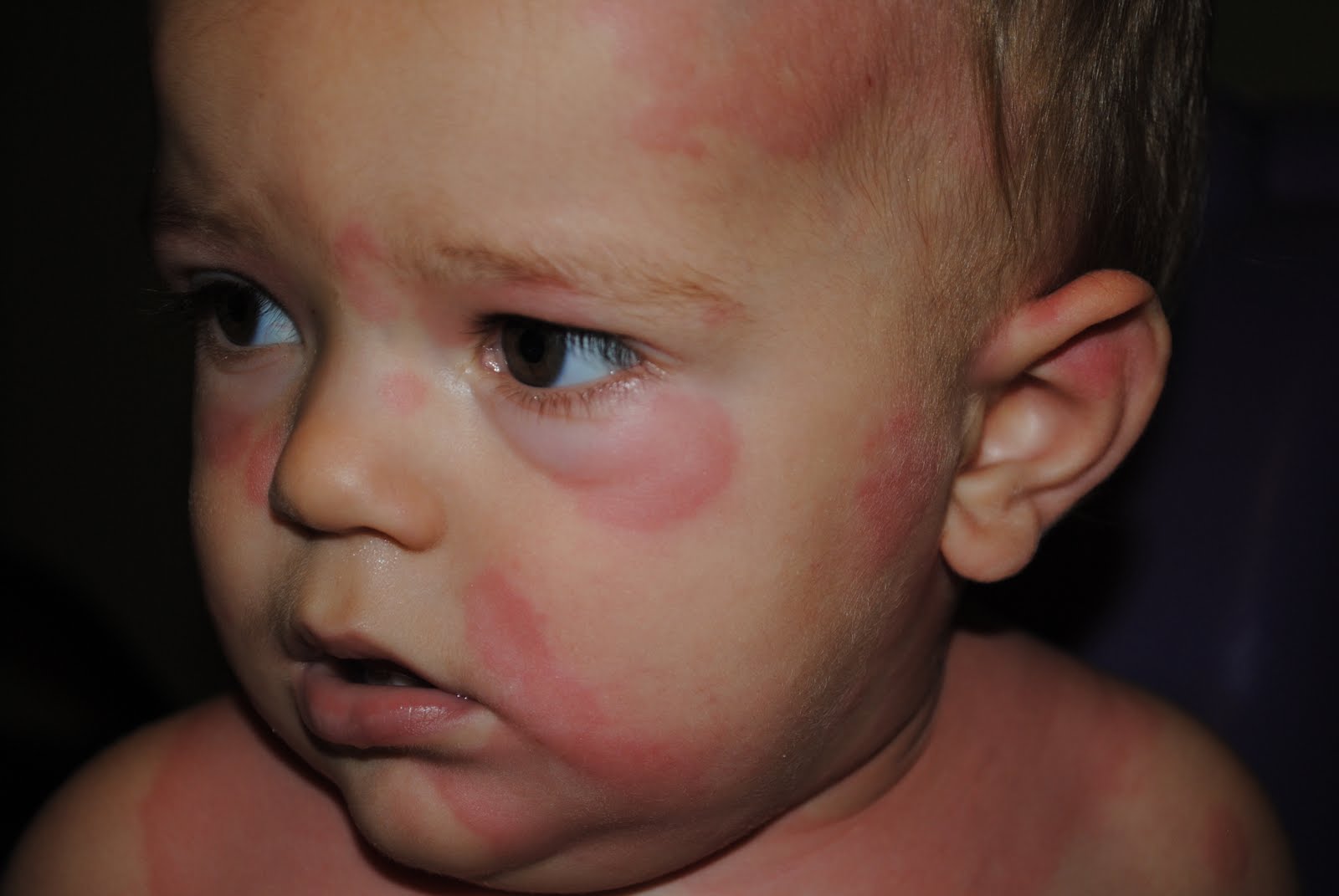 the-acree-family-a-bad-case-of-red-patches
