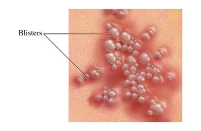 Causes of Fluid Filled Bumps on the Skin That Cause ...