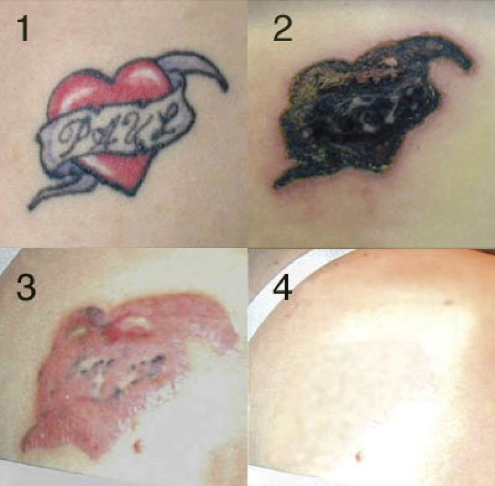 There are other methods of tattoo removal, but most of them are so ...