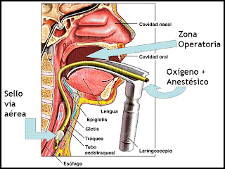 Explicación negligencia médica anestesia murió nena operada amígdalas