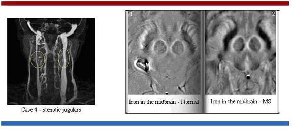 Iron In the midbrain