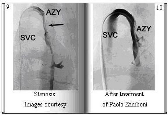 Stenosis Images Courtesy before & after treatment