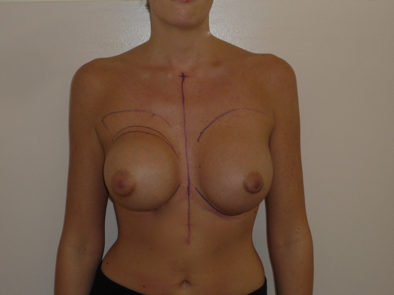 S Of Breast Encapsulation 15