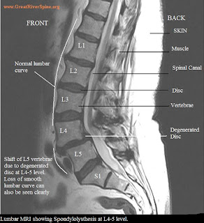Spinal manipulation and retrolisthesis