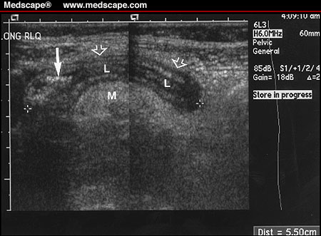 Appendix Sign Rlq RadiologySpirit