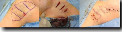 Surgery for excessive sweating armpits