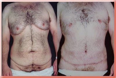 gynecomastia