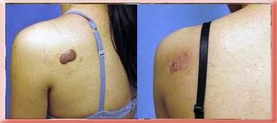 keloid back