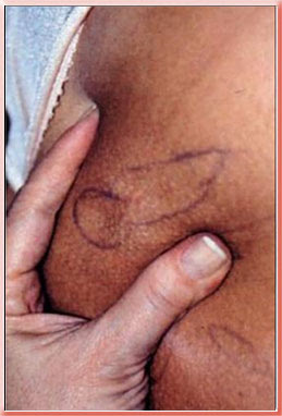 grade 1 cellulite