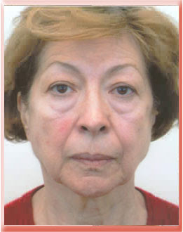 Tear trough exaggerated by protruding eyelid fat