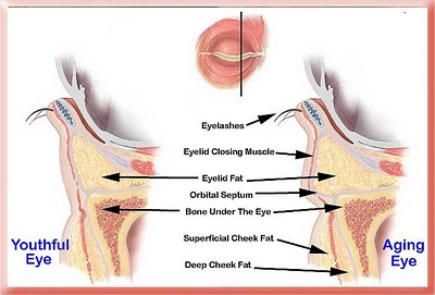 Tear trough exaggerated by protruding eyelid fat