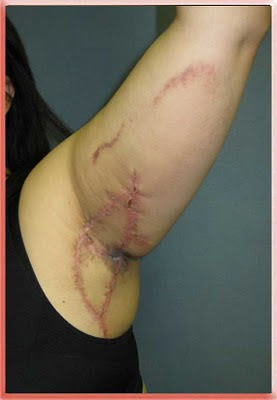 hidradenitis armpit