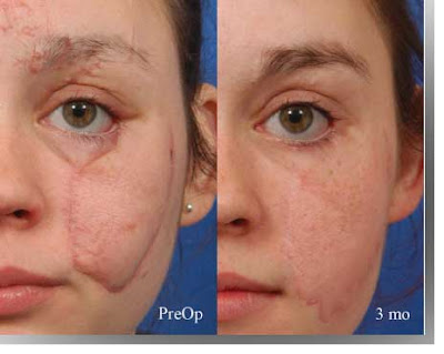 circular face scar