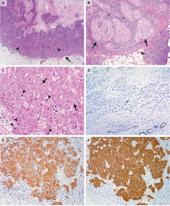 Triple-Negative Breast Cancer A Review On Current Concepts. ~ Oncowikia