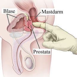 Hogyan kezelik a prostatitist fiatal férfiakban