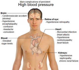 symptom of high blood pressure