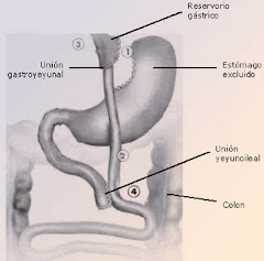 Mi Bypass Gastrico