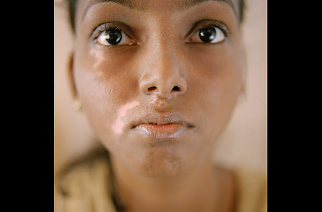 World Vitiligo Day - Ημέρα Λεύκης