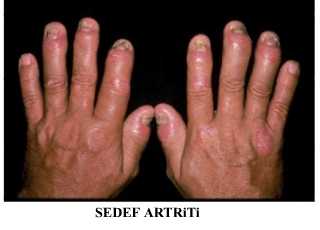 [sedef-hastaligi.jpg]