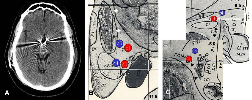 [ana21295-Hamani_et_al_Supplementary_Figure_1.jpg]