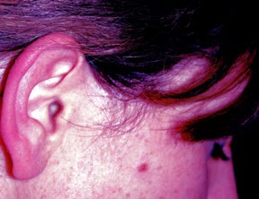 [red+ear+syndrome.JPG]