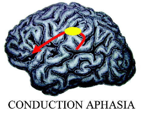 [conduction+aphasia.jpg]