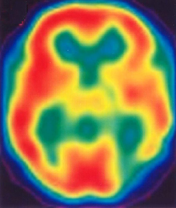 [Prosopometamorphopsia_SPECT.jpg]