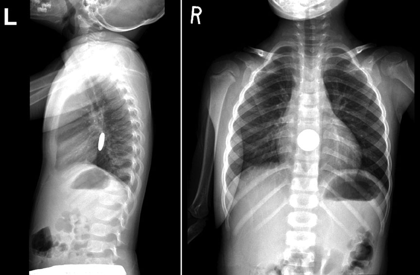 [xray+of+swallowed+coin.jpg]