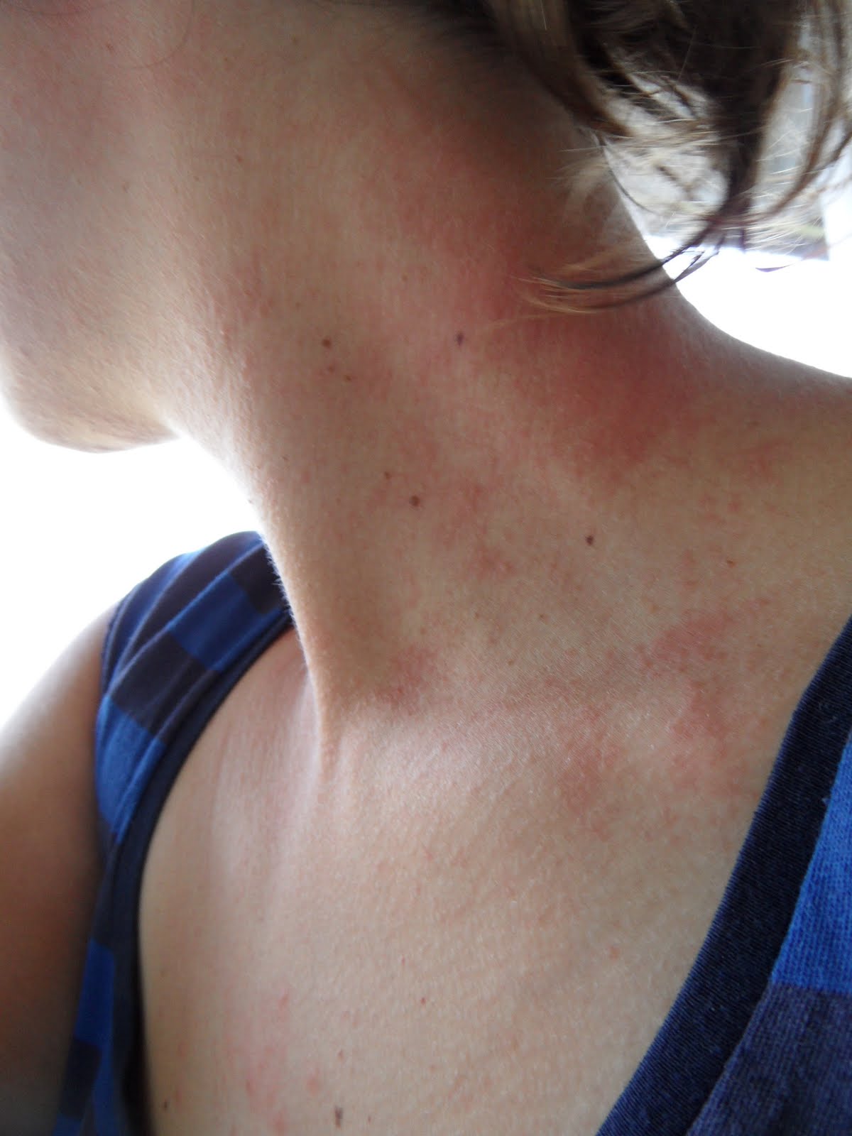 How Long Does It Take For A Mango Rash To Go Away