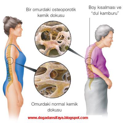 [KEMİK+ERİMESİ.jpg]