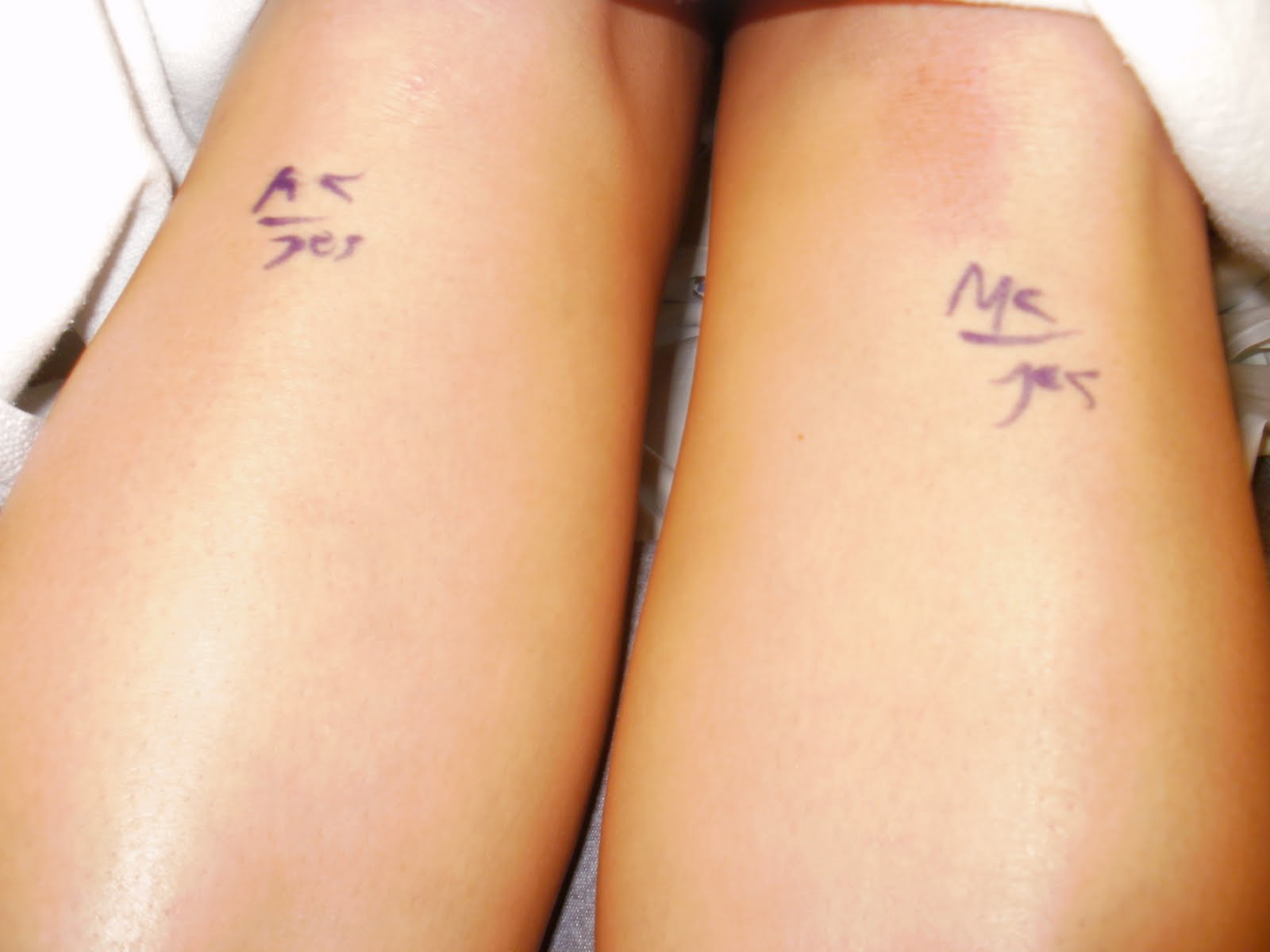 Hadrian's Journey with Compartment Syndrome: The Big Day Has Arrived ...