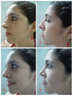 colombia rhinoplasty alarcn ovidio before surgery dr
