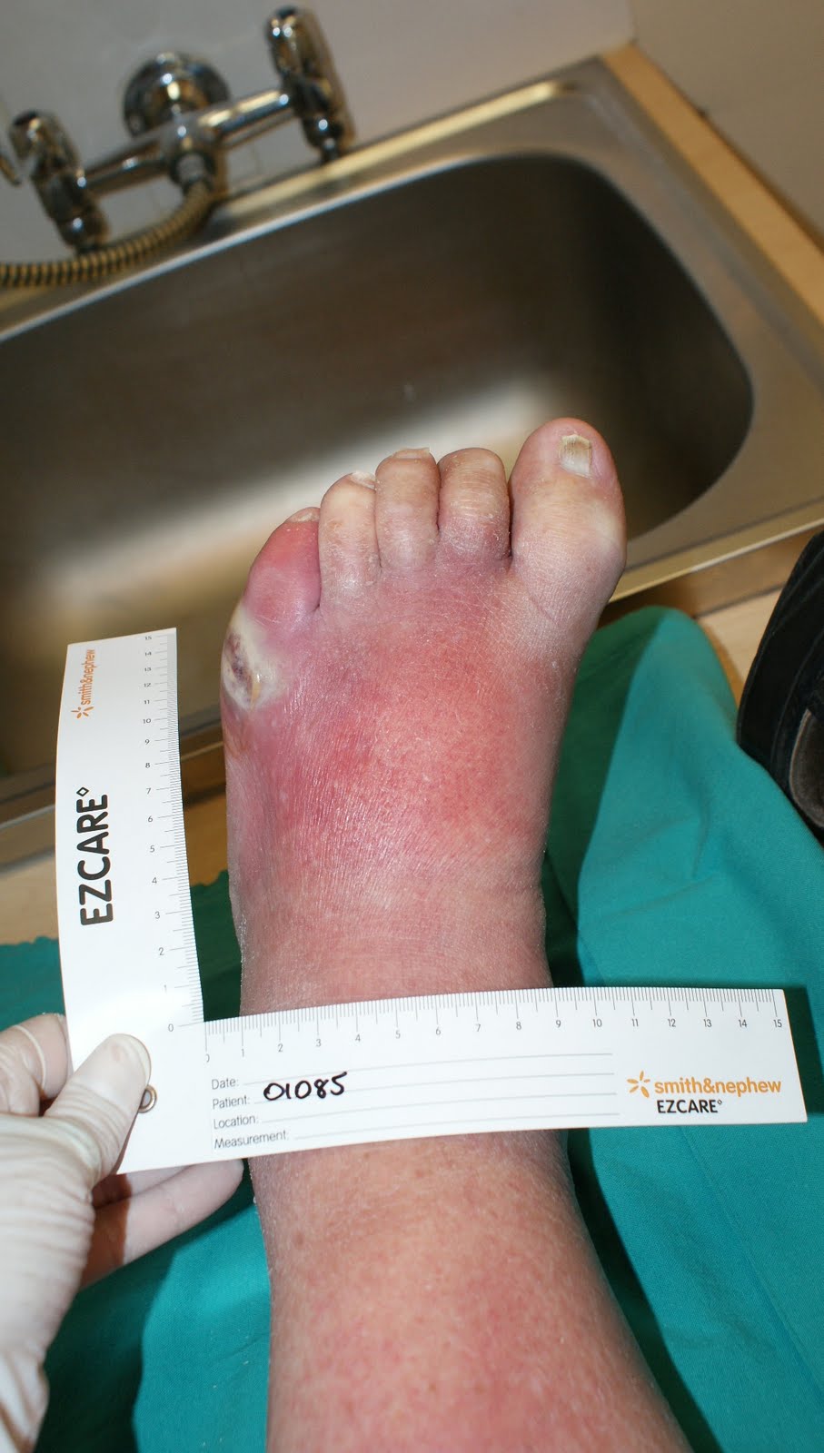 The Wound Healer Elective use of maggots in septic diabetic foot