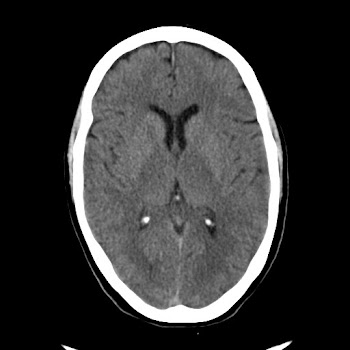 basal ganglia calcification,possible fahrs syndrome