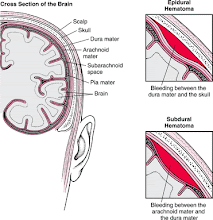 epidural hematoma.