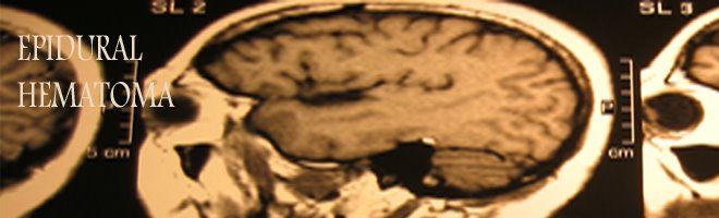 Epidural Hematoma