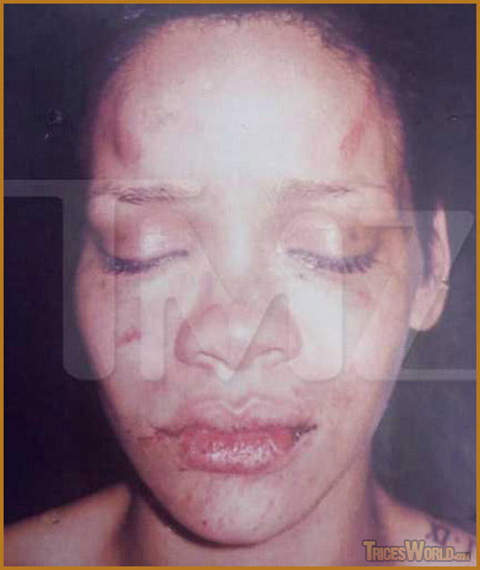 [Rihanna-Beating-Bruised-Injuries.jpg]