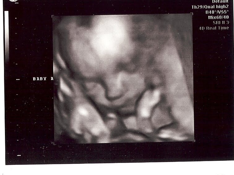 Raising the Rainey Twins Week 24 Ultrasound Still Girls, Now 100