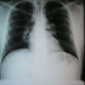 wajib sehat: Sarkoidosis (Sarcoidosis)