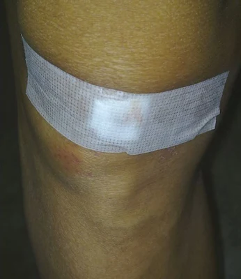 (R) knee superficial wound