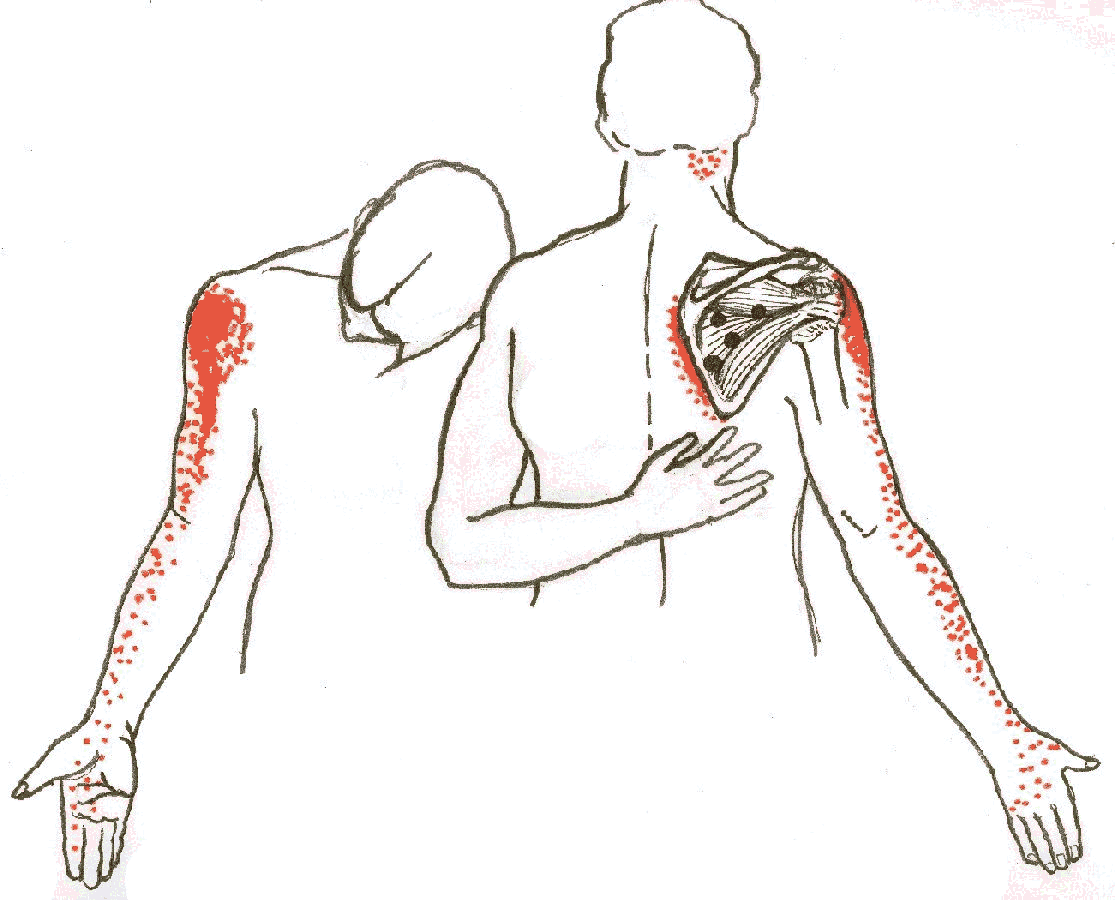 Zen Soul Massage & Acupuncture - NYC: That Pain Down Your Arm May Be
