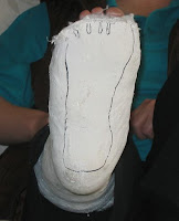 Foot in plaster