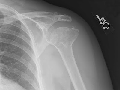 X-ray of the shoulder