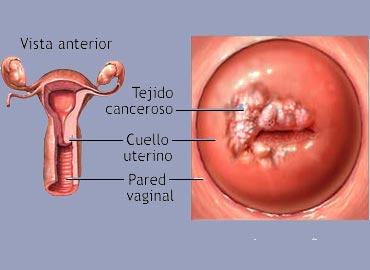 papiloma en ingles es