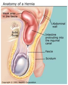 sex after a femoral hernia surgery sex after a femoral hernia surgery